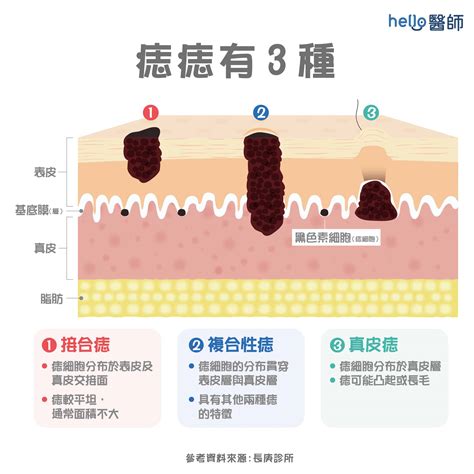 身體多痣|痣形成的原因？痣長毛、痣變多變大是痣病變？5招判。